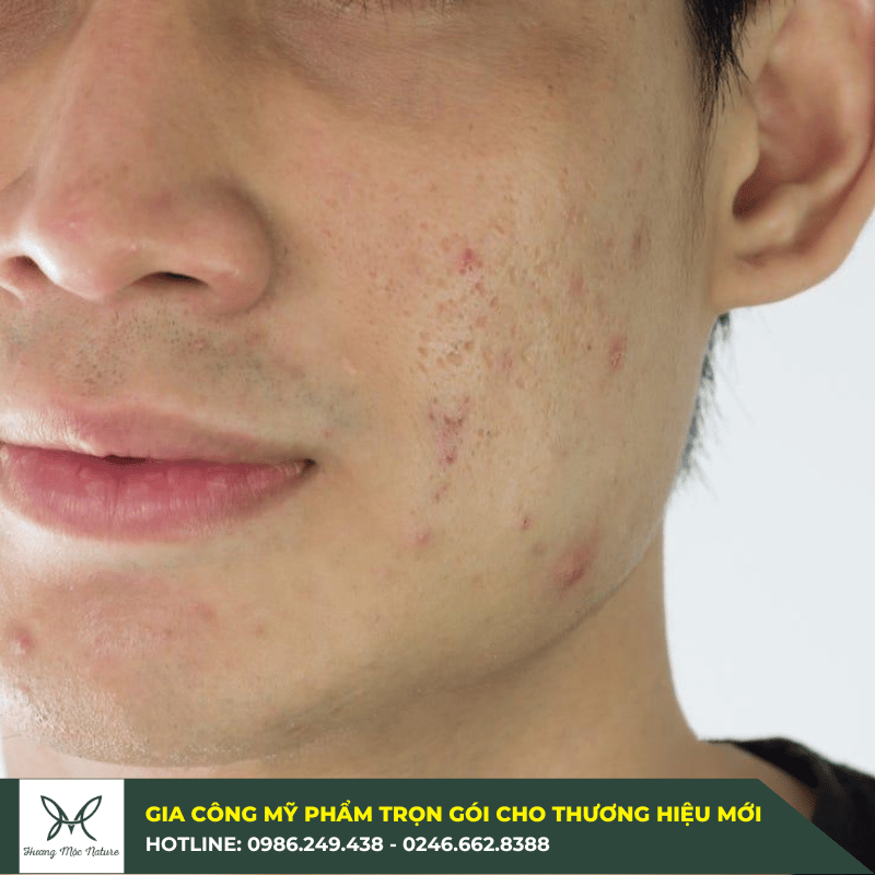 Gia công serum ngừa mụn tiết kiệm được chi phí và giá thành gia công hợp lý